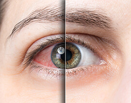 Запалене око в порівнянні зі здоровим